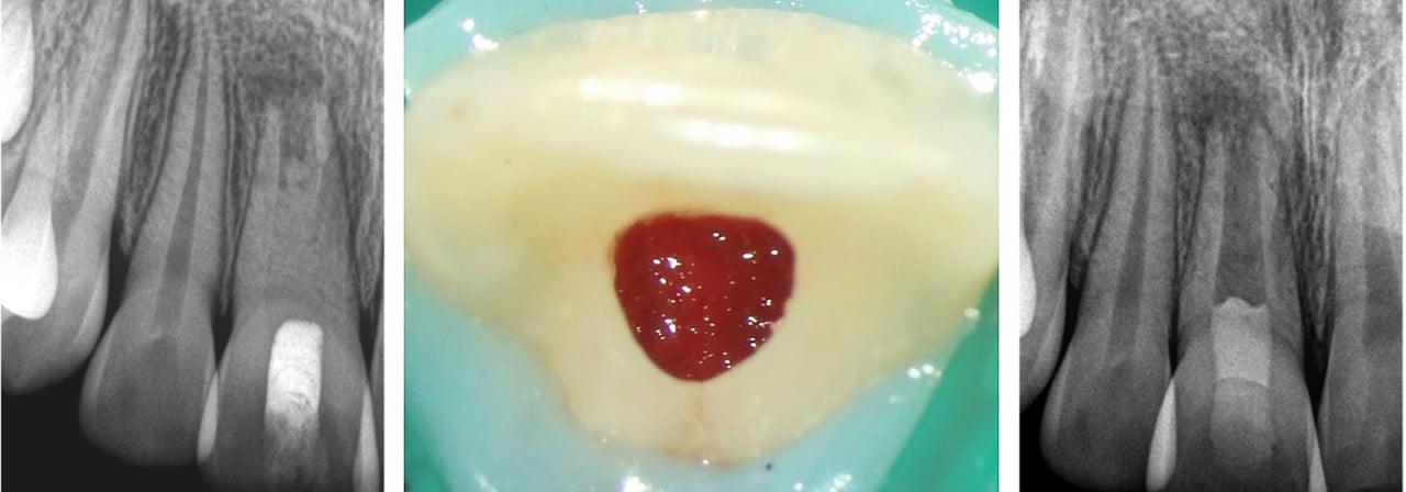 revitalisation dents permanentes immatures nécrosées