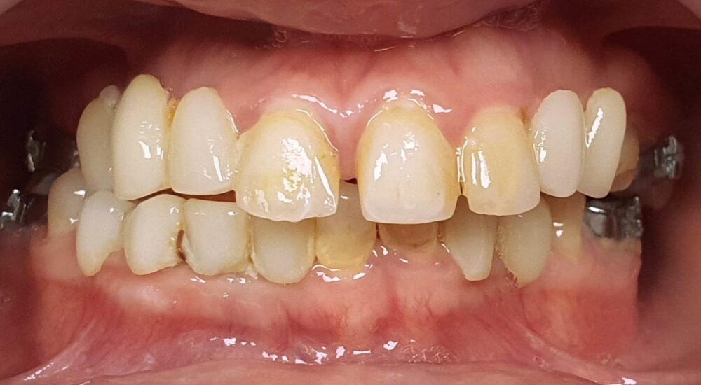 Réhabilitation implantaire d&rsquo;une patiente atteinte d&rsquo;oligodontie