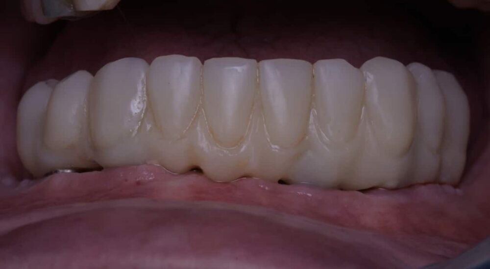 Quatre implants « Tissue Level » pour un sourire