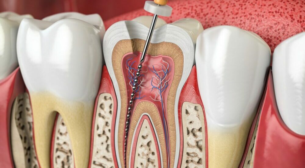 endodontique
