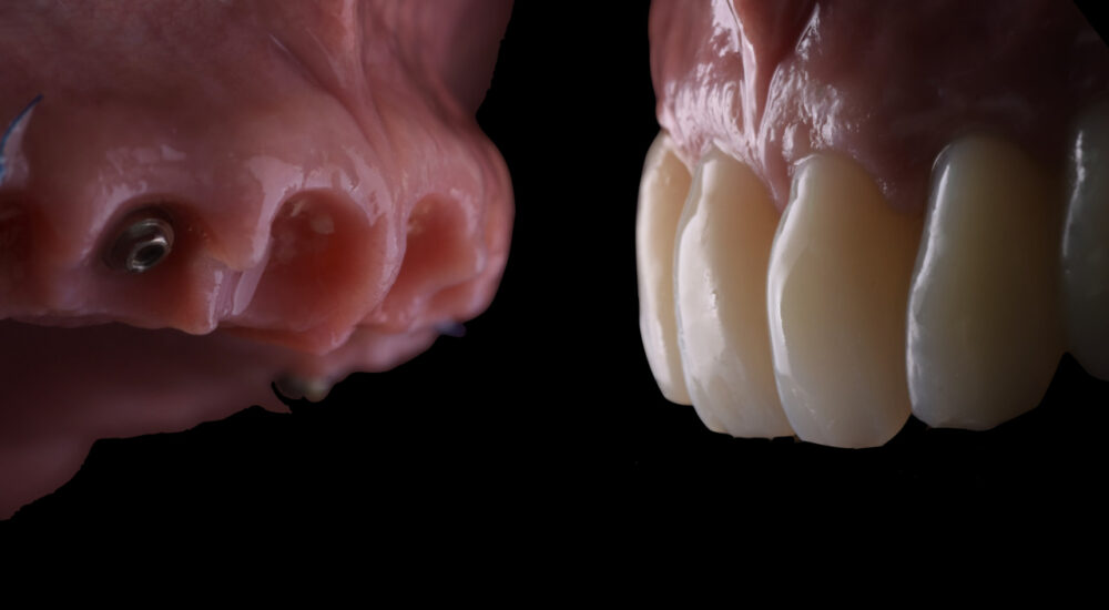 4 à 6 implants pour un sourire grâce au Full Arch