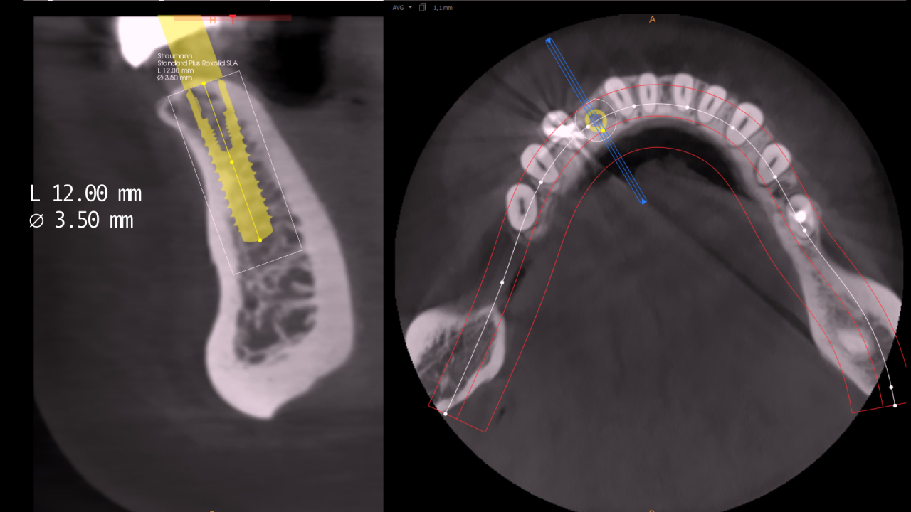 planification implant