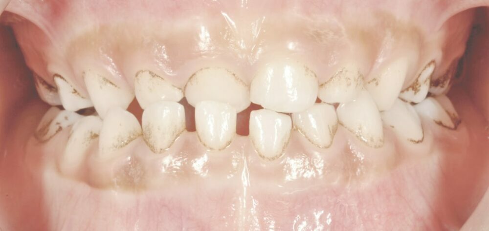 dysmorphose