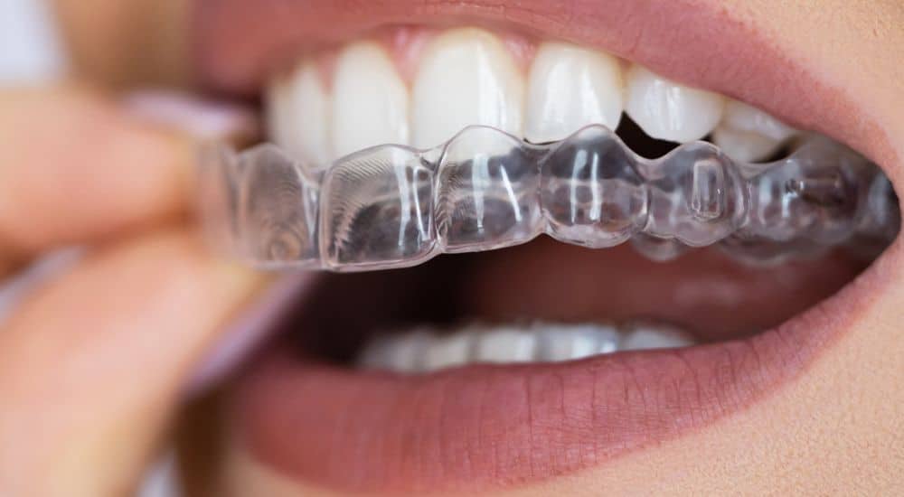 Aligneur dentaire, gouttière, traçabilité orthodontie