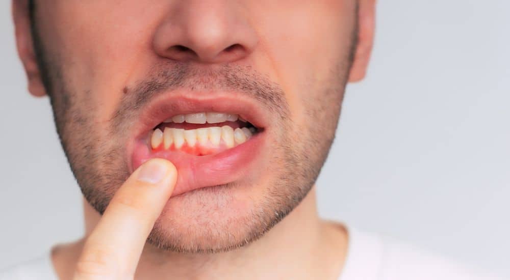 Jeune homme montrant des gencives rouges qui saignent, traitement maladie parodontale