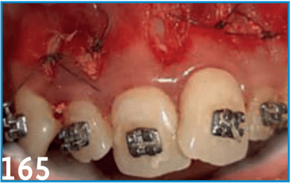 Existe-t-il une ostéogénèse induite suite aux traitements orthodontiques accélérés ? À propos d’une série de cas