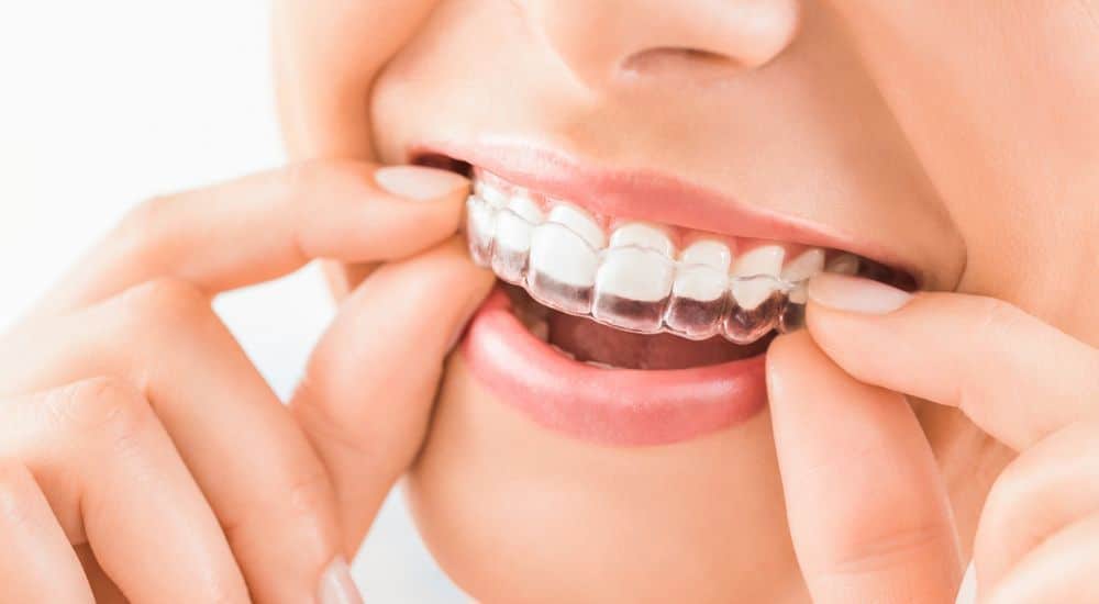 Jeune femme positionnant un aligneur dentaire invisible. Orthodontie en ligne