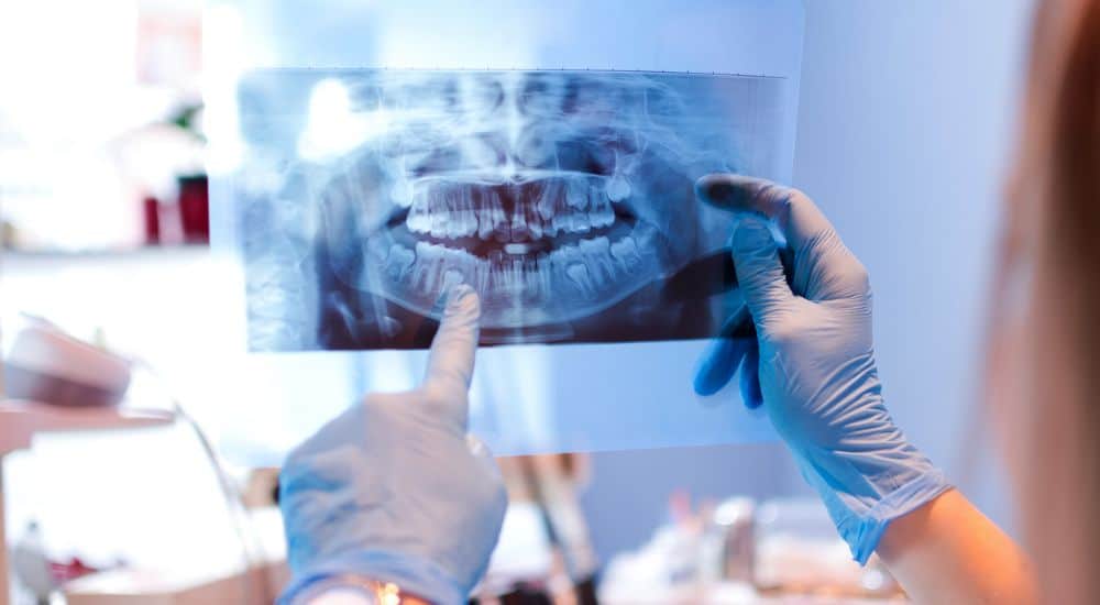 Gros plan de femme médecin pointant à dents radiographie au cabinet dentaire. Ostéonécrose de la mâchoire