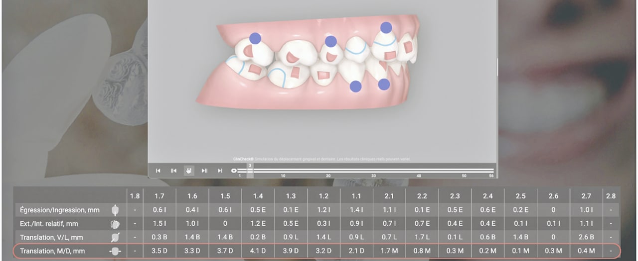 Tableau des mouvements dentaires.