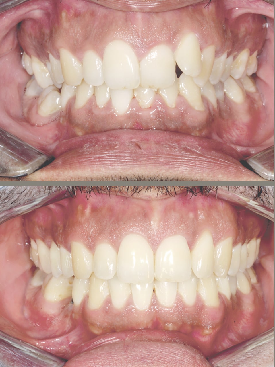 distalisation par aligneurs