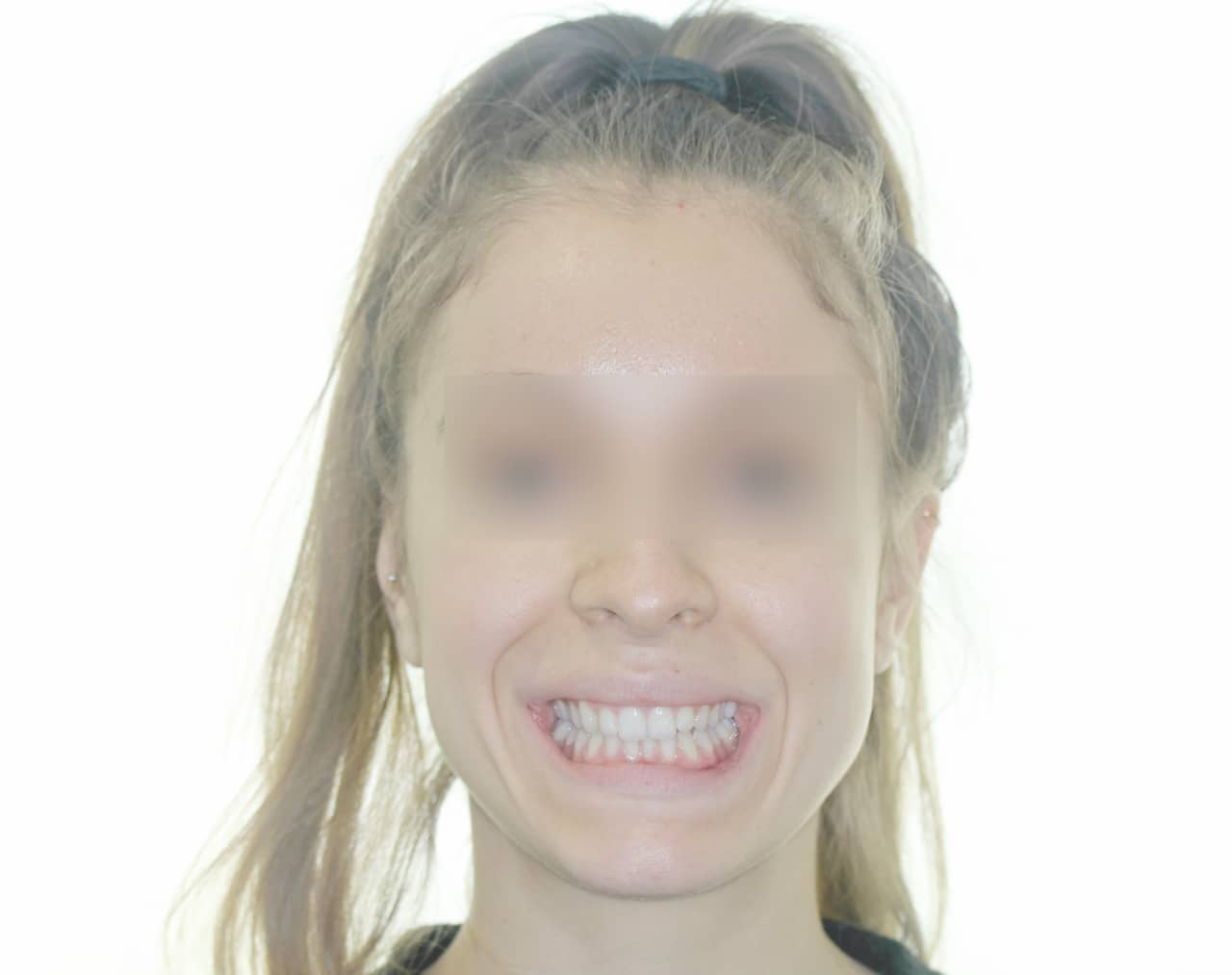 début de traitement