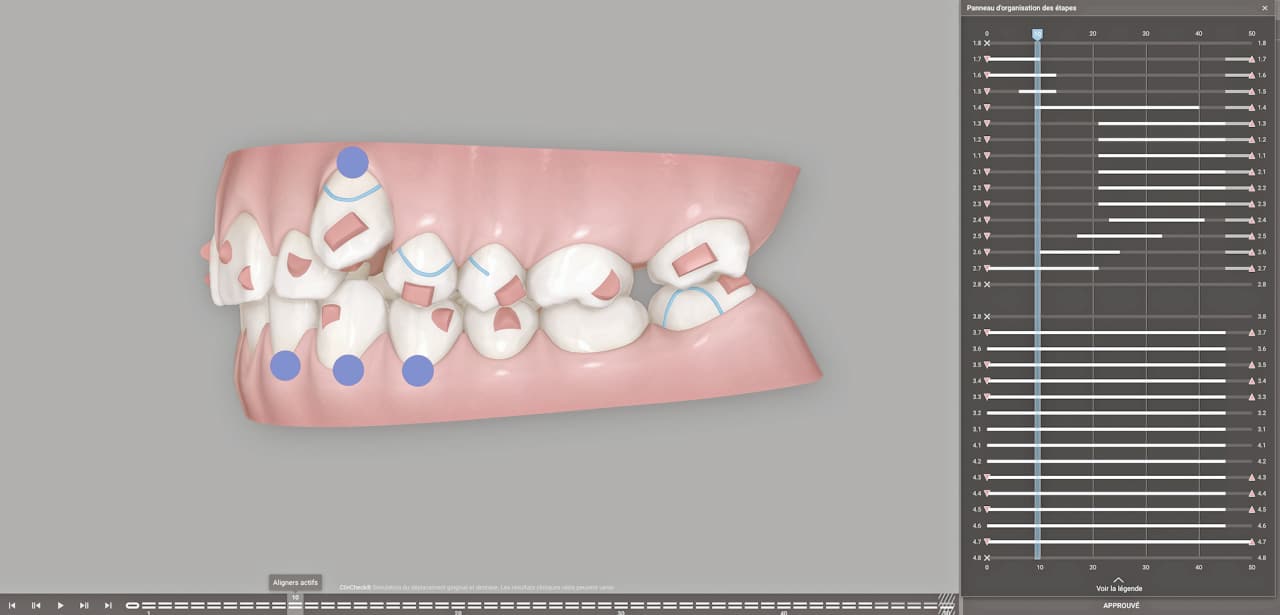 progression de la distalisation