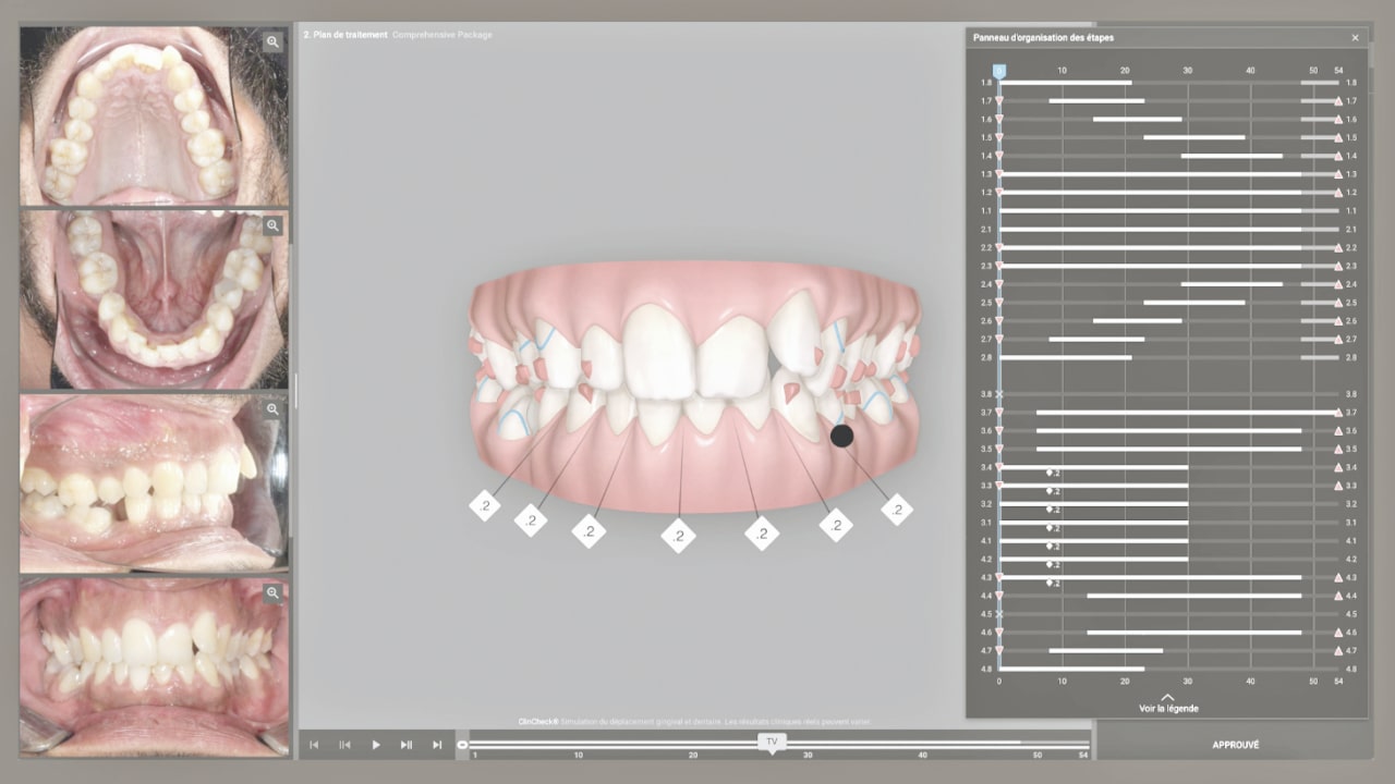 Distalisation avec démarrage esthétique