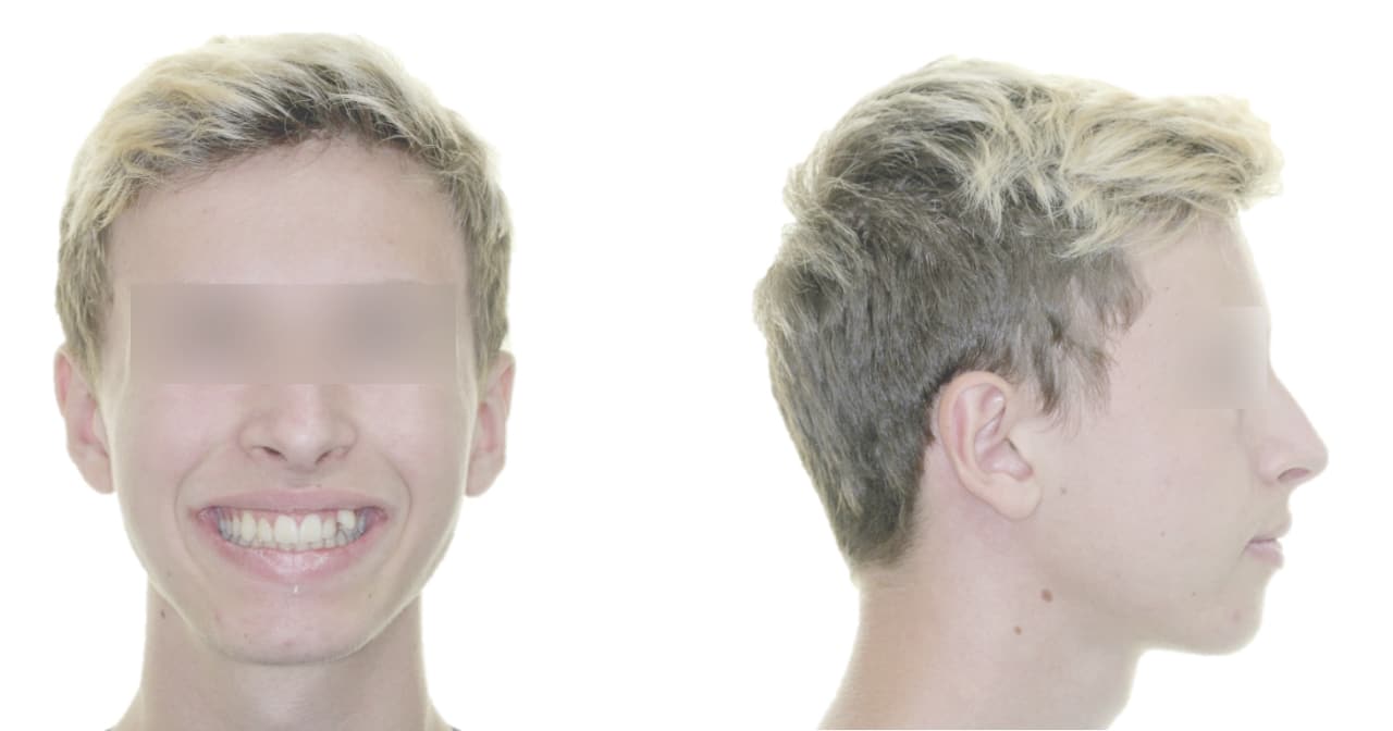 Cas clinique 1. Fig.1 à 5 : Début de traitement.