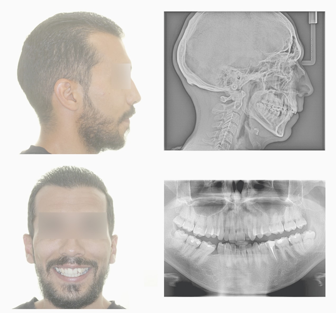 2 bilatérale, bi-endoalvéolie