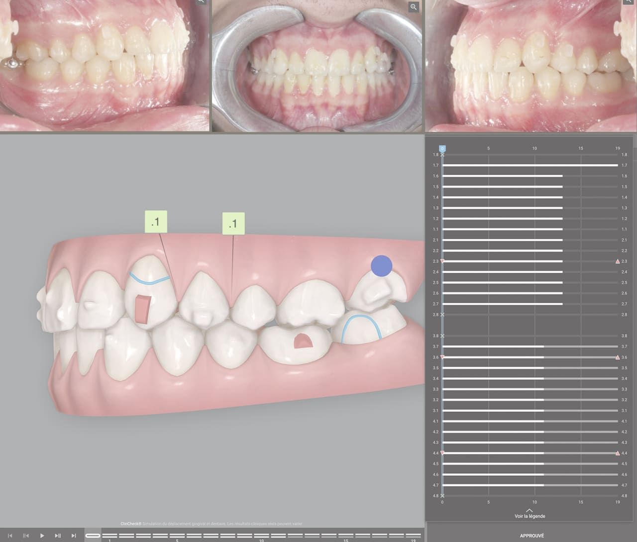Fig.10, 11 : Deuxième phase.
