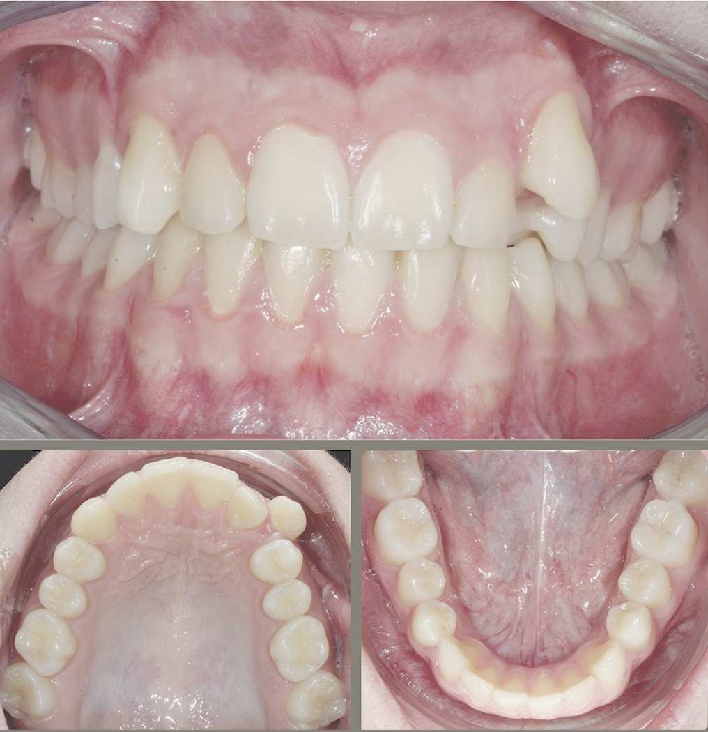 distalisation par aligneurs