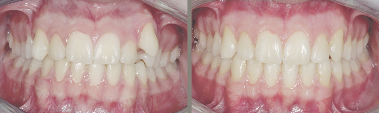 Fig.12 à 17 : Fin de traitement.