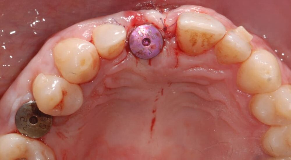 implant