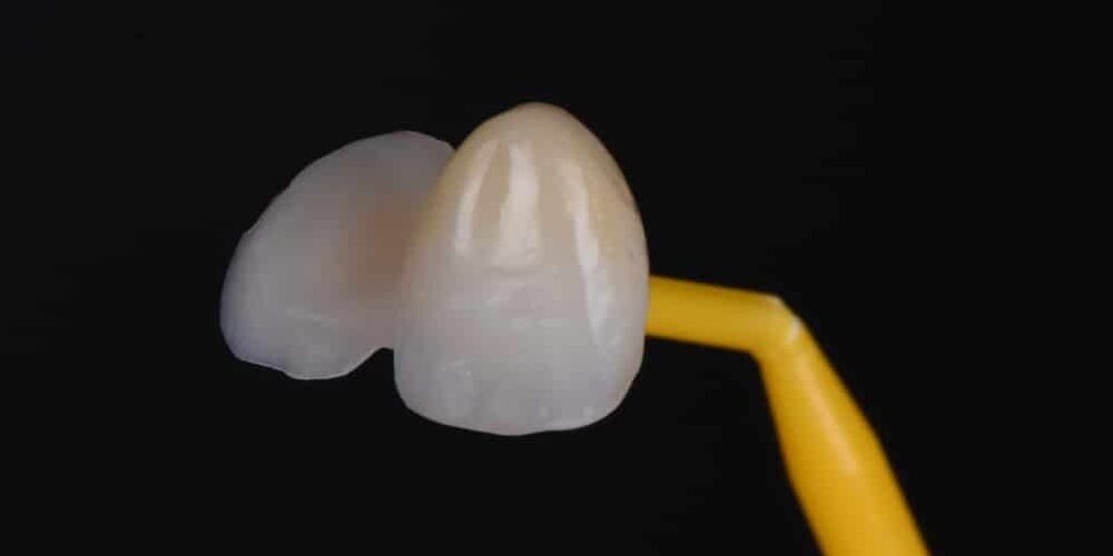 Bridge Collé Cantilever