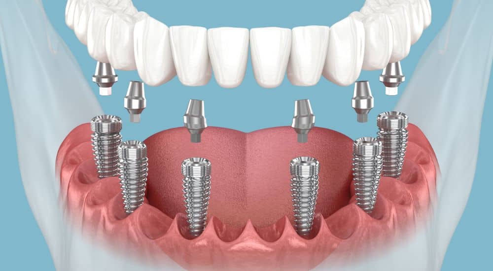 Prothèse mandibulaire avec gencive, Les nanocristaux de cellulose, une piste prometteuse pour les implants