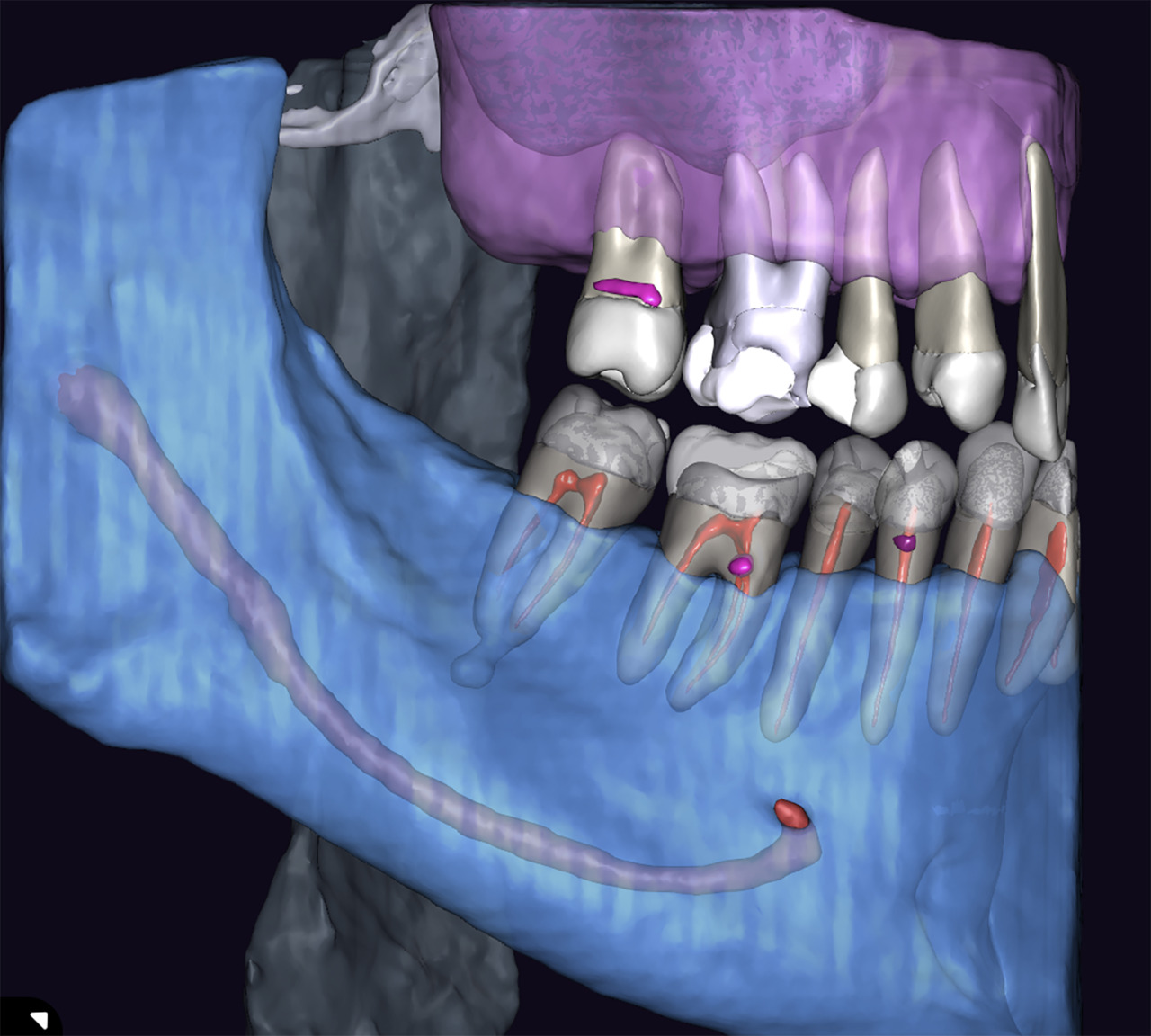 cas complexes endodontie