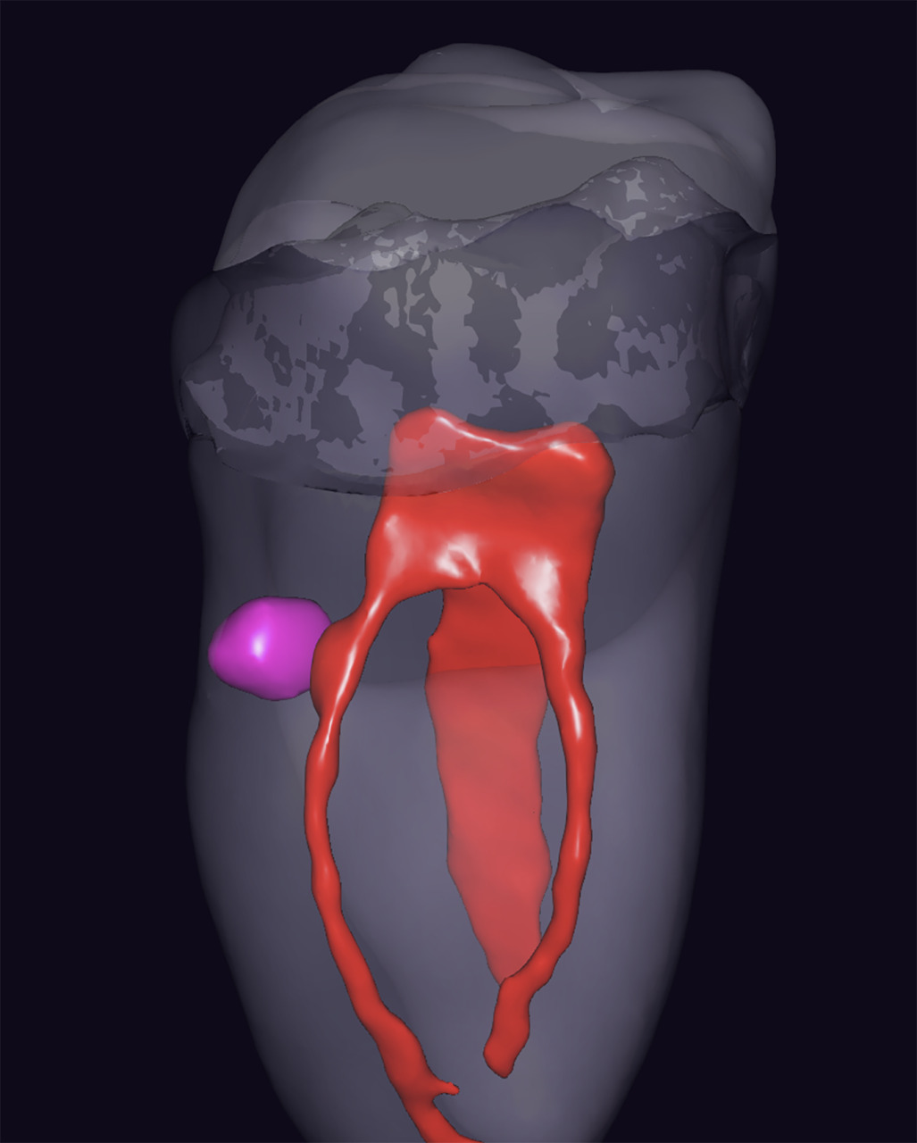 Fig.5a et 5b : Reconstitutions 3D montrant la communication entre la lésion de résorption et la pulpe radiculaire du canal MV.