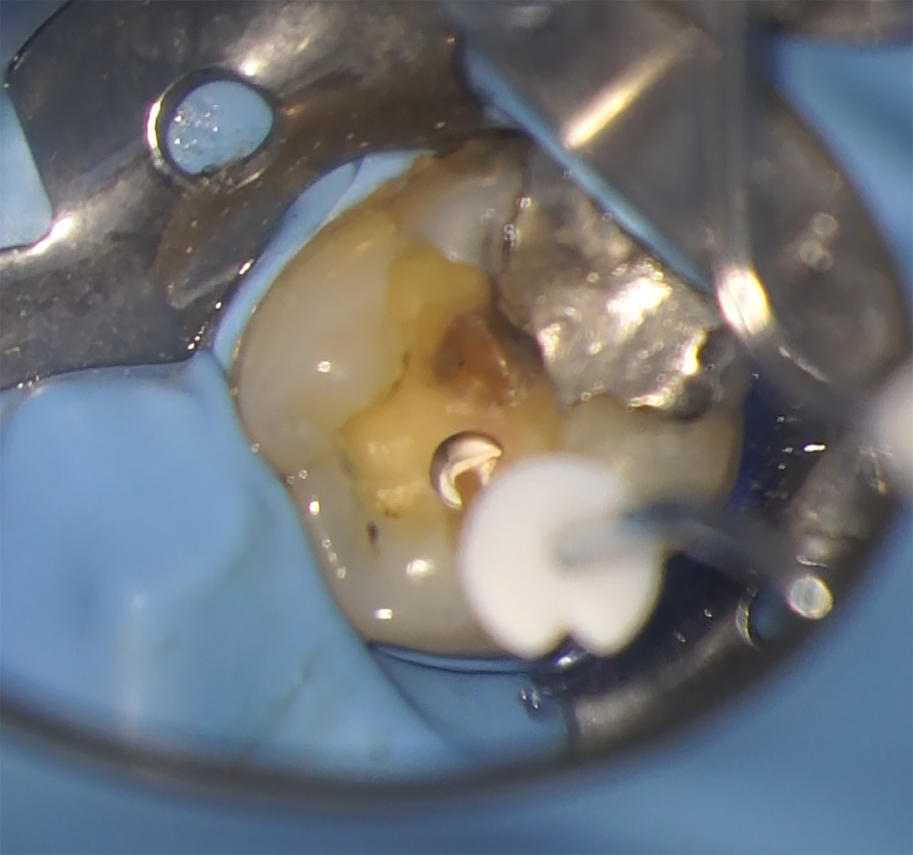 Fig.10 : Séchage du canal avant obturation.