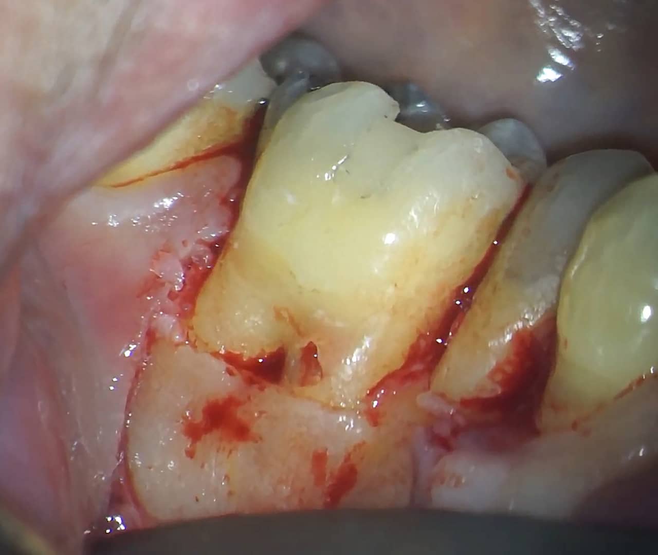 Fig.14 : Restauration de la cavité d'accès avec un composite fluide collé.