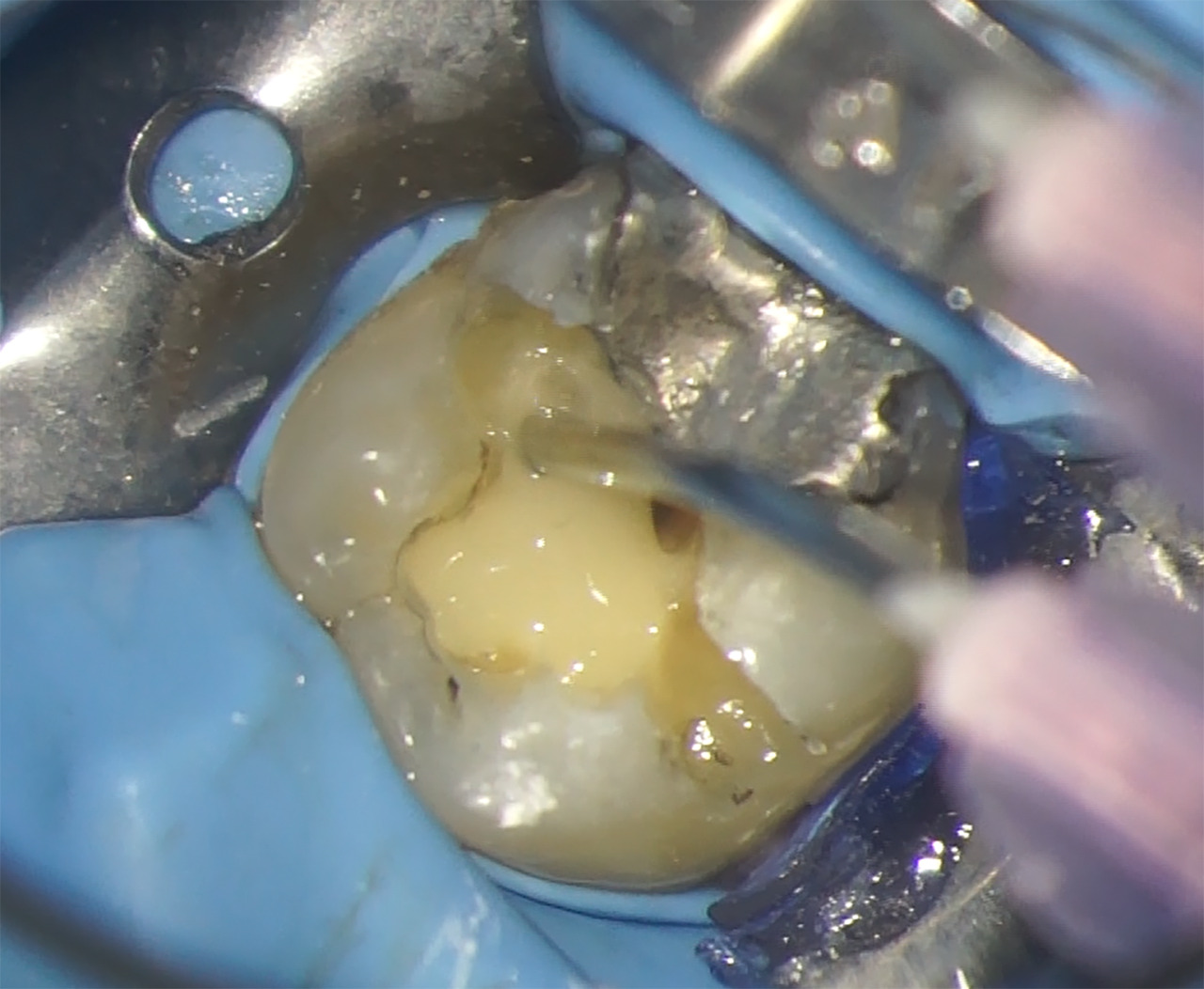 Fig.13 : Application de l'adhésif sur le fond de la cavité.