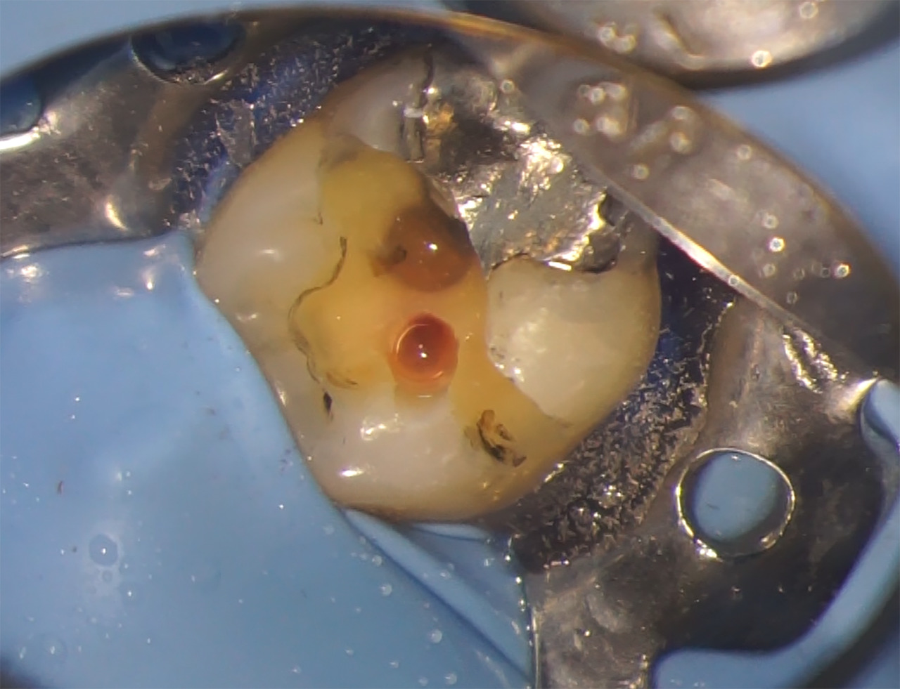 résorption cervicale externe