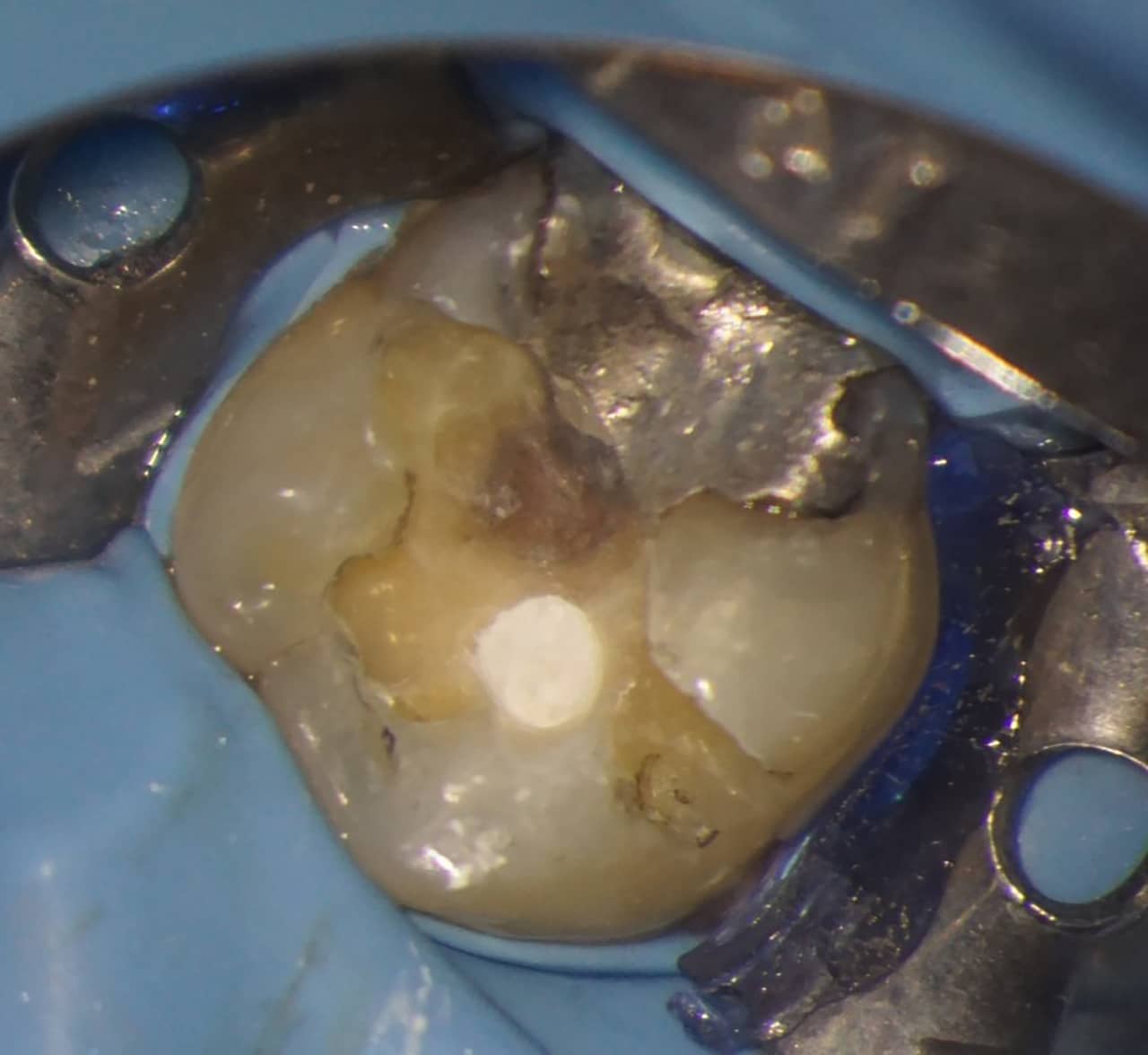 Fig.11 : Obturation canalaire avec le Neo Sealer (Zarc, Espagne) et un cône de Gutta percha ZS1.résorption cervicale externe