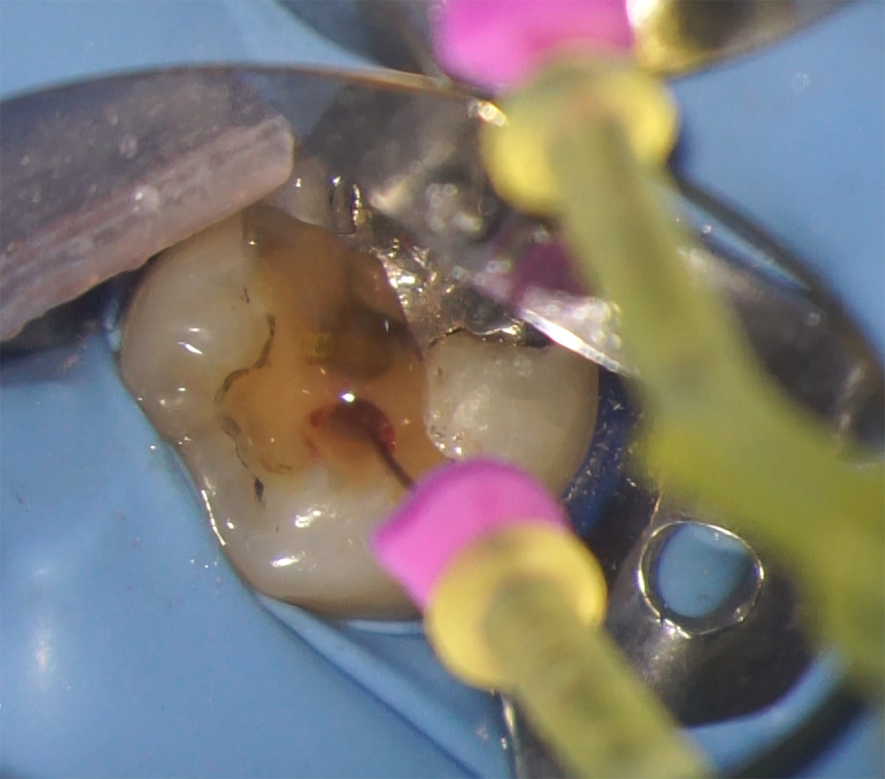 Fig.8 : Utilisation du ZS1 pour la mise en forme canalaire.