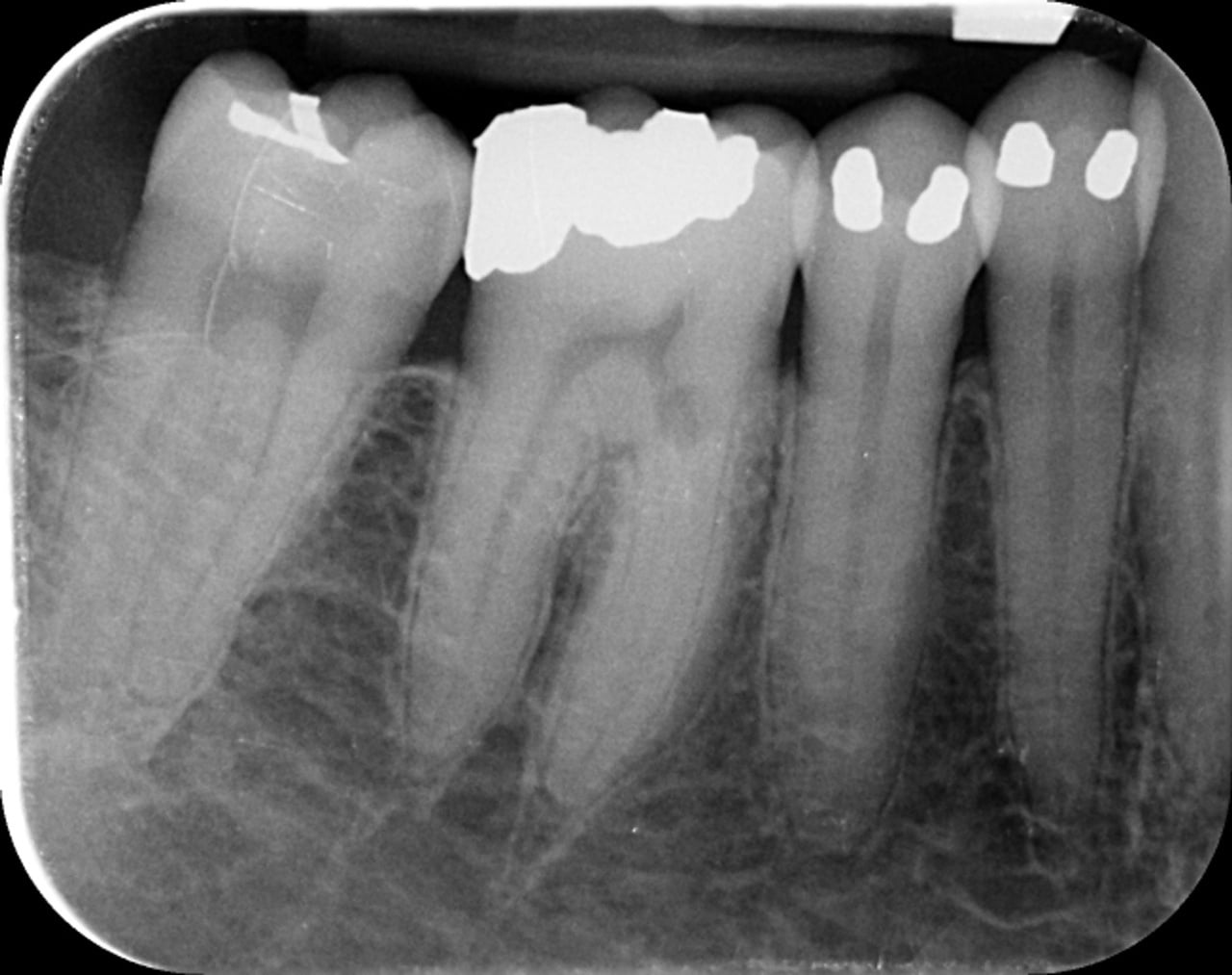 résorption cervicale externe