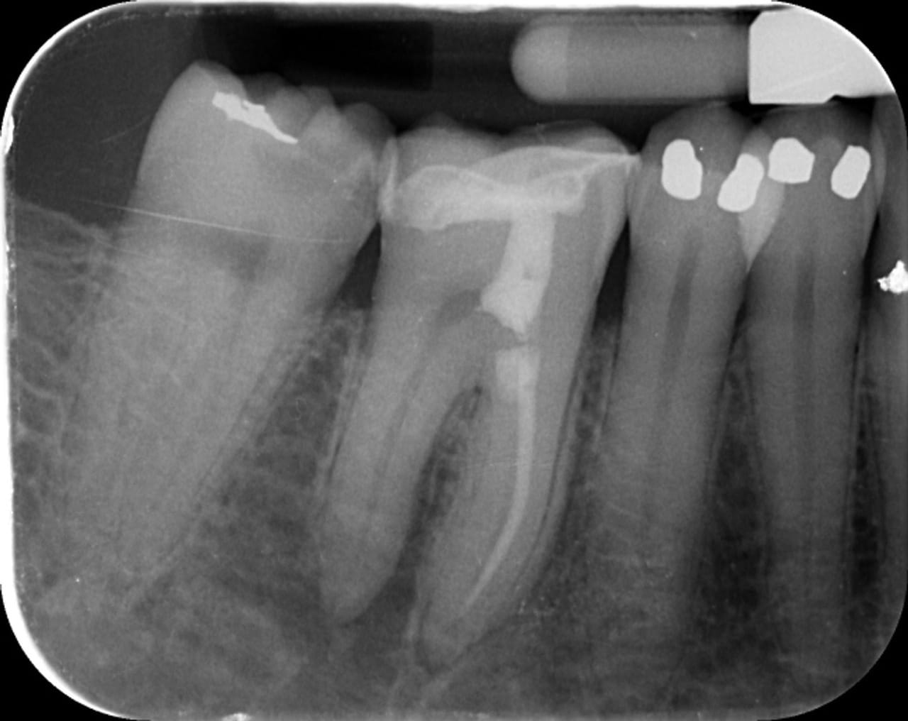 Fig.19b : Vue occlusale de la dent après collage de l'inlay/onlay.