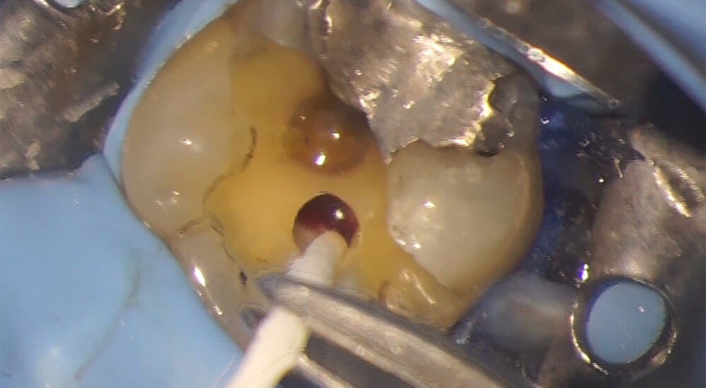 L&rsquo;endodontie à l&rsquo;ère du numérique : révolution technologique et préservation tissulaire