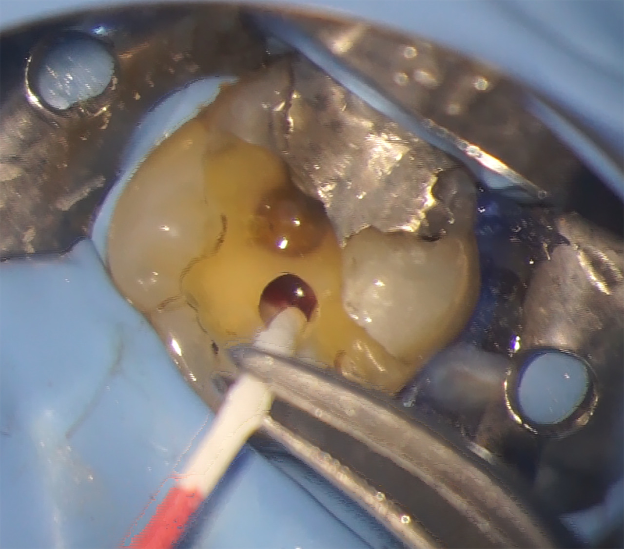 endodontie