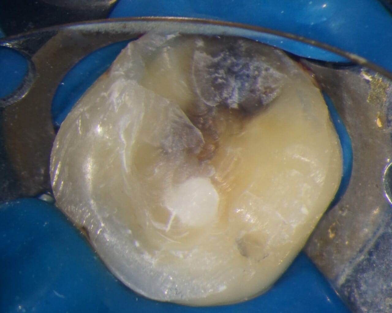 Fig.18 : Radiographie postopératoire prise avec un angulateur selon la technique des plans parallèles.