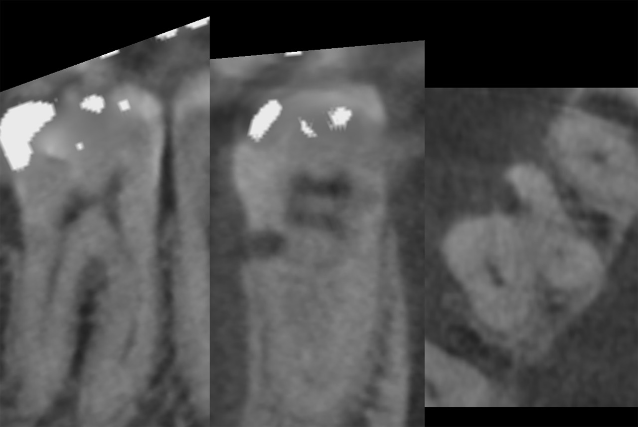résorption cervicale externe Fig.1 : Radiographie préopératoire - cliché pris selon la technique des plans parallèles avec un angulateur.