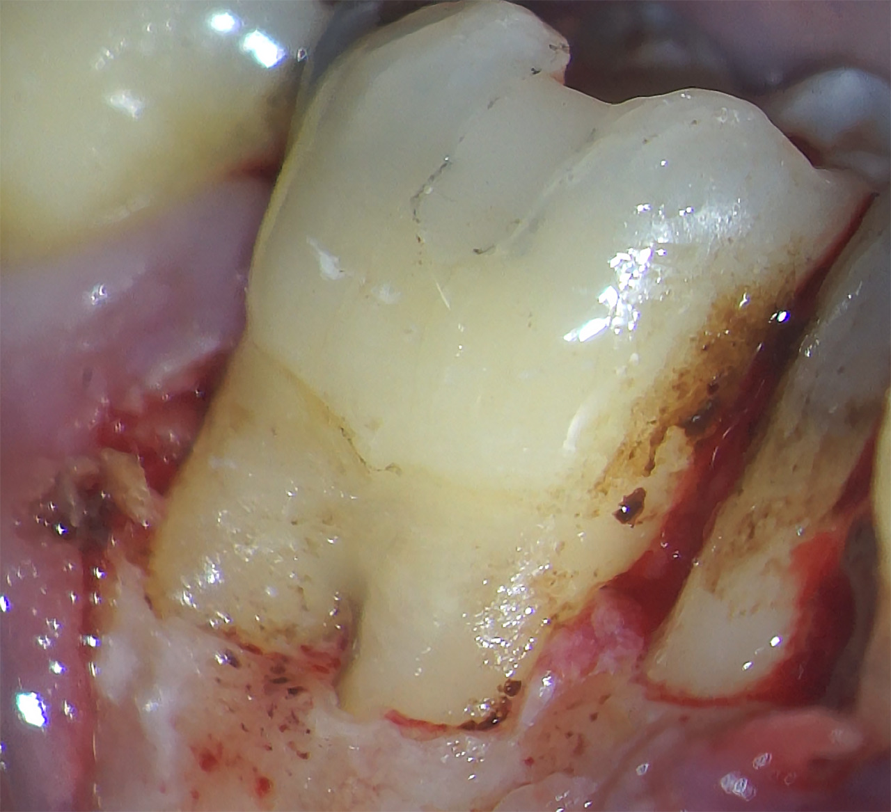 Fig.16 : Préparation de la cavité de résorption à l'aide d'un insert ultra-sonore de chirurgie endodontique.résorption cervicale externe