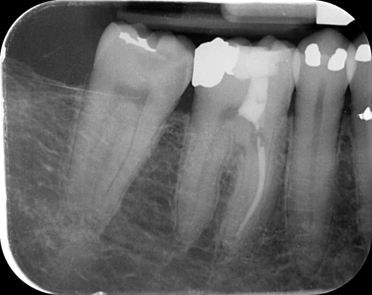 Fig.17 : Vue vestibulaire de la racine après obturation au composite fluide collé.