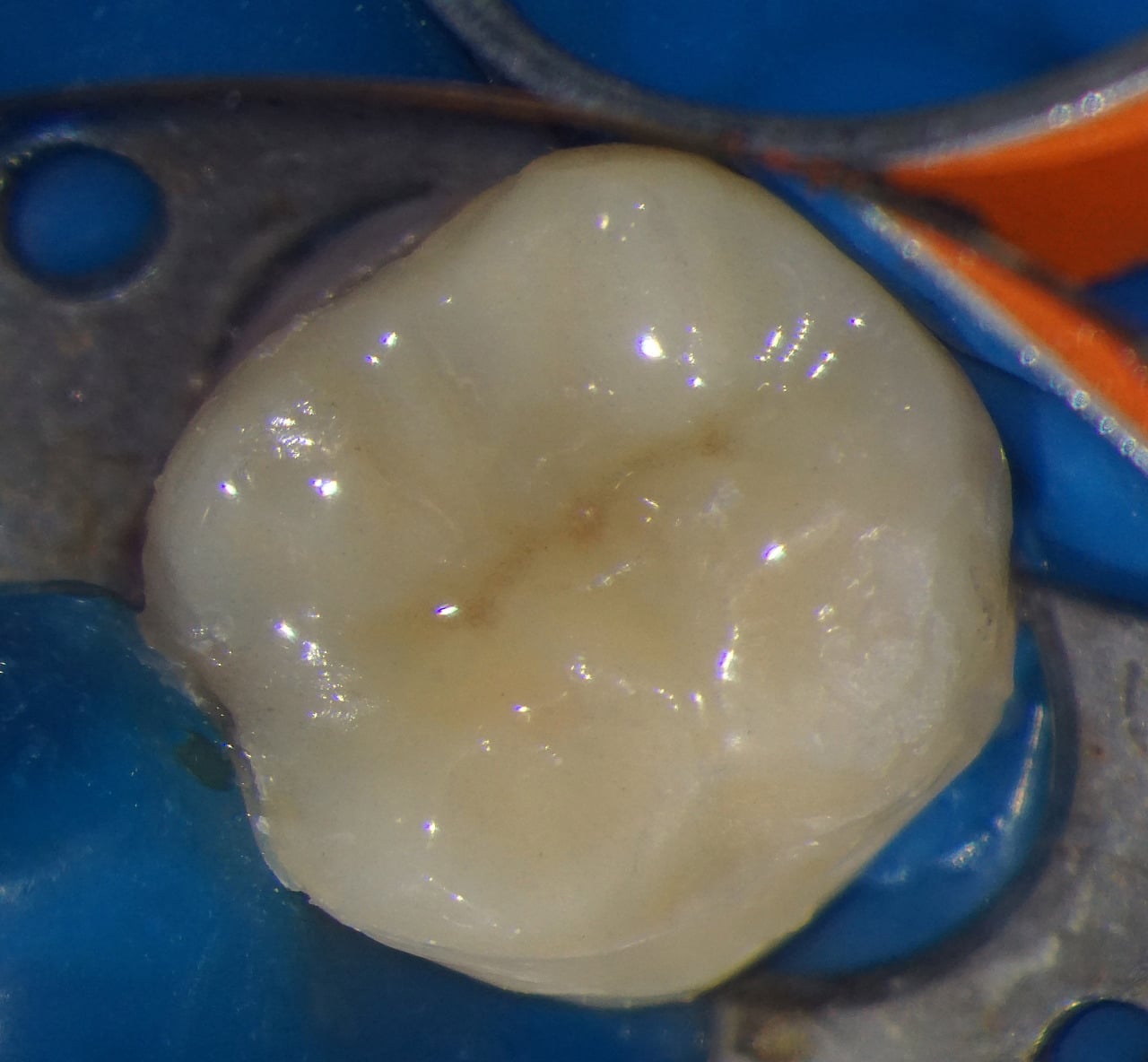 Fig.19a : Vue de la dent préparée avant le collage de l'inlay/onlay.