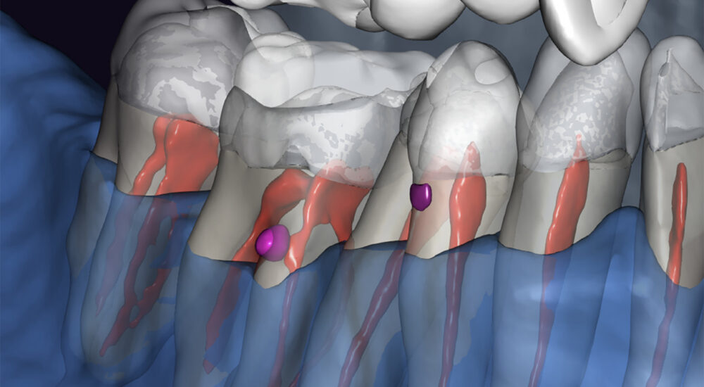 Résorption cervicale externe : traitement a minima guidé par l&rsquo;imagerie 3D
