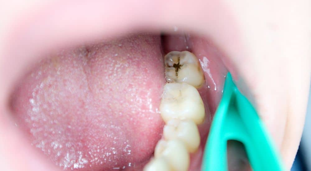 Dent cariée dans une bouche ouverte. Prévention de la carie dentaire