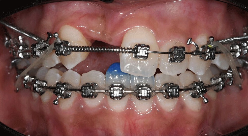 Prise en charge d’une malocclusion iatrogène sévère