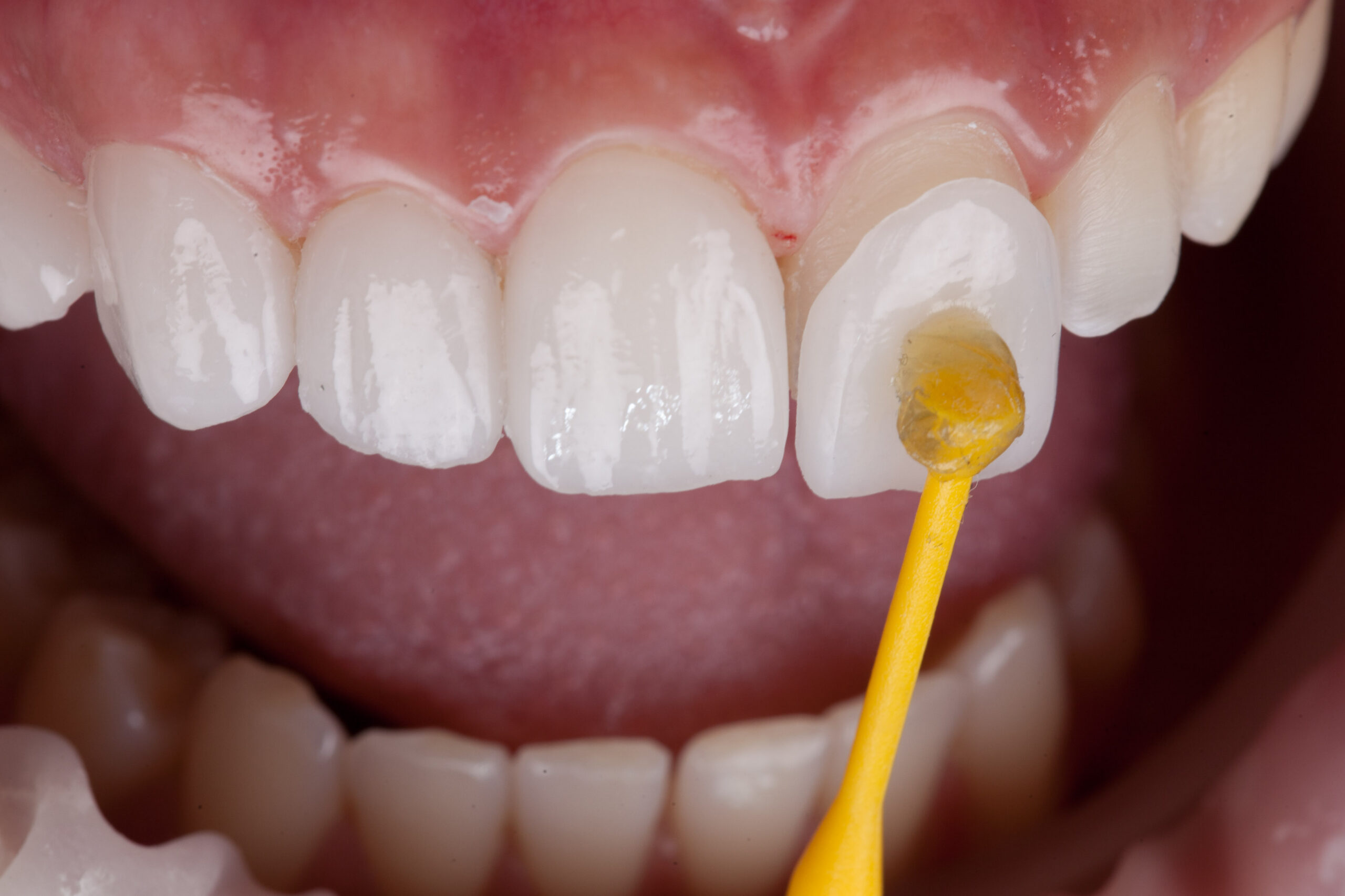 dental,,smile,design,,white,teeth