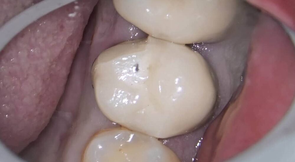 Retraitement endodontique orthograde