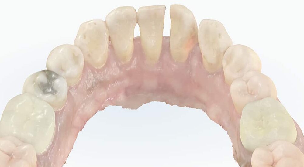 Gestion des espaces en omnipratique : orthodontie et contention fibrée