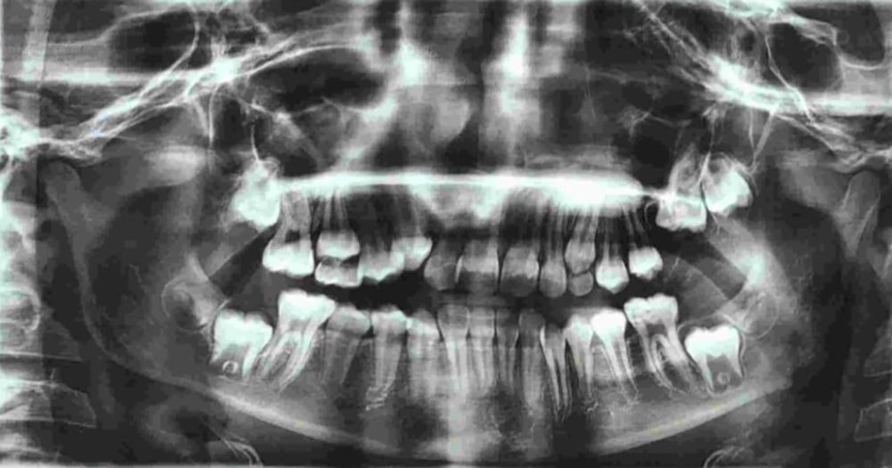 Retard d&rsquo;éruption et dents incluses : diagnostic et gestion de différentes situations cliniques