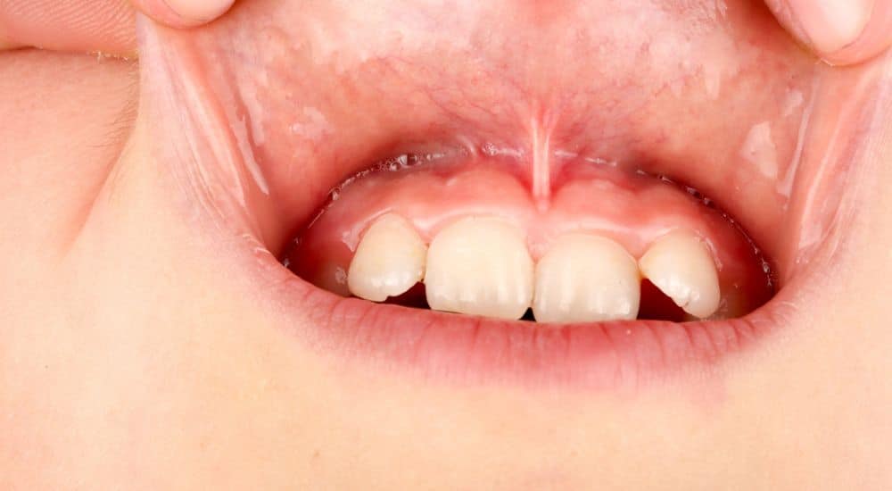 Frein labial : quand et pourquoi opter pour la frénectomie ?